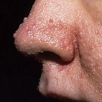 Angiofibrom în nas din ceea ce apare