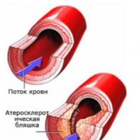 Hipertansiyon və diabetes mellitus