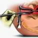 Uterus boşluğunun divarlarının küretajı